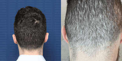 Case 8695 - 18-24 year old man treated with Beard Transplant