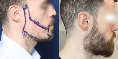 Case 8696 - 18-24 year old man treated with Beard Transplant