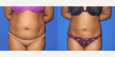 Case 8869 - Woman treated with Liposuction