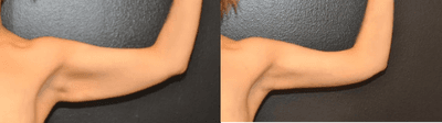 Case 8870 - 34 year old woman treated with Arm Lift, Liposuction