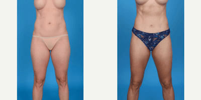 Case 8871 - 35-44 year old woman treated with Abdominal Etching, Belly Button Surgery, Diastasis Recti Repair, Drainless Tummy Tuck, Liposcu