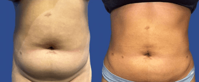 Case 8872 - Woman treated with Liposuction