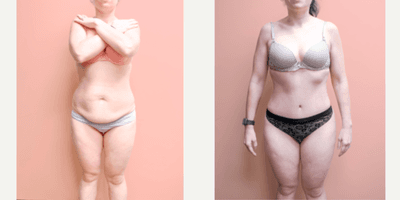 Case 8873 - 35-44 year old woman treated with Tummy Tuck, Liposuction