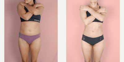 Case 8874 - 35-44 year old woman treated with Liposuction