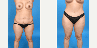 Case 8875 - 35-44 year old woman treated with Abdominal Etching, Diastasis Recti Repair, Drainless Tummy Tuck, Liposculpture, Liposuction, M