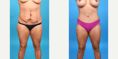 Case 8876 - 25-34 year old woman treated with Abdominal Etching, Diastasis Recti Repair, Drainless Tummy Tuck, Liposuction, Mini Tummy Tuck,
