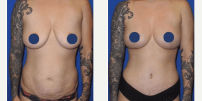 Case 8877 - Woman treated with Breast Lift, Breast Fat Transfer, Tummy Tuck, Liposuction, Mommy Makeover