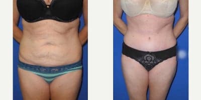Case 9 - Woman treated with Tummy Tuck