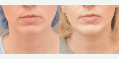 Case 9109 - 25-34 year old woman treated with Chin Implant