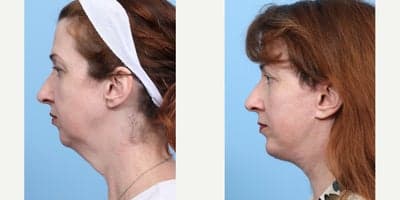 Case 9110 - 45-54 year old woman treated with Chin Implant, Deep Plane Facelift