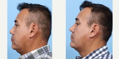 Case 9111 - 55-64 year old man treated with Chin Implant, Facial Fat Transfer