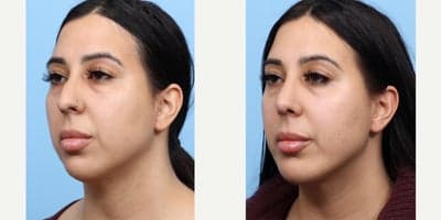 Case 9112 - 25-34 year old woman treated with Chin Implant, Rhinoplasty