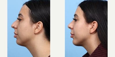 Case 9113 - 25-34 year old woman treated with Chin Implant, Rhinoplasty