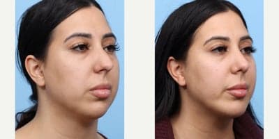 Case 9114 - 25-34 year old woman treated with Chin Implant, Rhinoplasty
