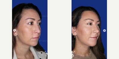 Case 9115 - 35-44 year old woman treated with Chin Implant, Revision Rhinoplasty