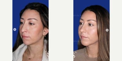 Case 9116 - 35-44 year old woman treated with Revision Rhinoplasty, Chin Implant