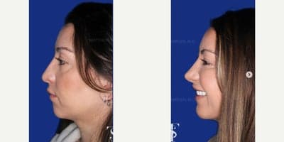 Case 9117 - 35-44 year old woman treated with Revision Rhinoplasty, Chin Implant