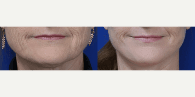 Case 9229 - Woman treated with Neck Lift, Facelift