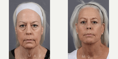 Case 9231 - Woman treated with Deep Plane Facelift, Facelift, Neck Lift, Facial Fat Transfer, Eyelid Surgery
