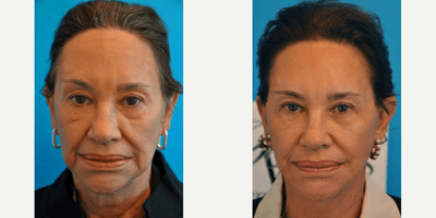 Case 9232 - Woman treated with Neck Lift