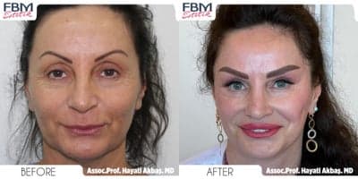 Case 9233 - 55-64 year old woman treated with Deep Plane Facelift, Neck Lift, Eyelid Surgery, Lip Lift