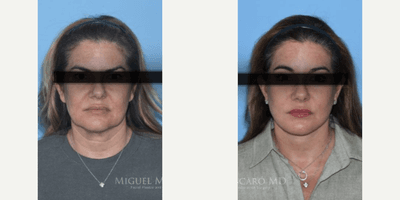 Case 9234 - Woman treated with Neck Lift