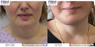 Case 9235 - 45-54 year old man treated with Neck Lift, Lower Facelift