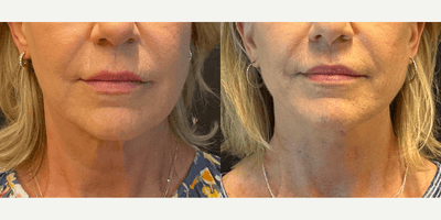 Case 9236 - Woman treated with Neck Lift