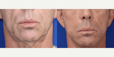 Case 9237 - 55-64 year old Man treated with Neck Lift