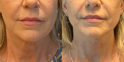 Woman treated with Neck Lift