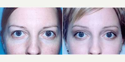 Case 9458 - Woman treated with Brow Lift