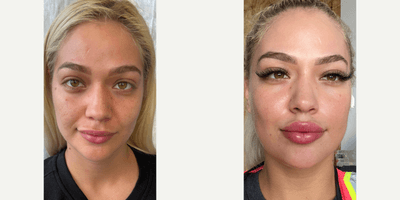 Case 9675 - 25-34 year old woman treated with CO2 Laser, Halo Laser, TCA Peel