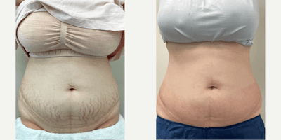 Case 9676 - 25-34 year old woman treated with Halo Laser
