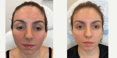 Case 9677 - ACNE SCAR COMBINATION | HYBRID LASER + CO2