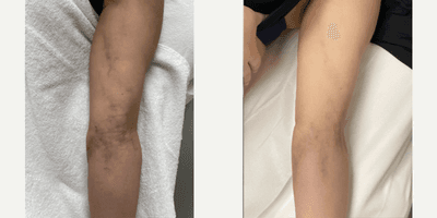 Case 9678 - 25-34 year old woman treated with Halo Laser, Potenza