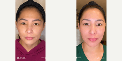 Case 9680 - 25-34 year old woman treated with Bellafill, Halo Laser, ProFractional Laser