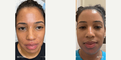 Case 9681 - 25-34 year old woman treated with Halo Laser