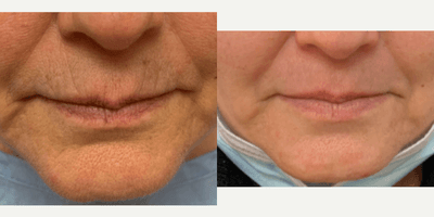 55-64 year old woman treated with Laser Resurfacing