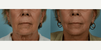 65-74 year old woman treated with Facelift, SMAS Facelift, Neck Lift, Eyelid Surgery, Brow Lift, Facial Fat Transfer, Laser Resu