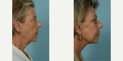 65-74 year old woman treated with Facelift, SMAS Facelift, Neck Lift, Eyelid Surgery, Brow Lift, Facial Fat Transfer, Laser Resu