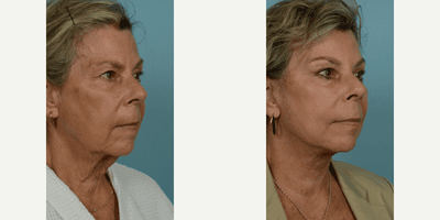65-74 year old woman treated with Facelift, SMAS Facelift, Neck Lift, Eyelid Surgery, Brow Lift, Facial Fat Transfer, Laser Resu