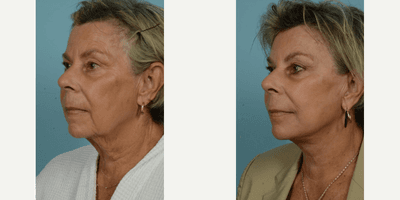 65-74 year old woman treated with Facelift, SMAS Facelift, Neck Lift, Eyelid Surgery, Brow Lift, Facial Fat Transfer, Laser Resu