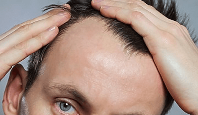 Scalp Reduction