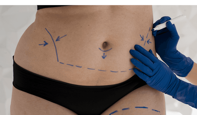 Lap Band Surgery