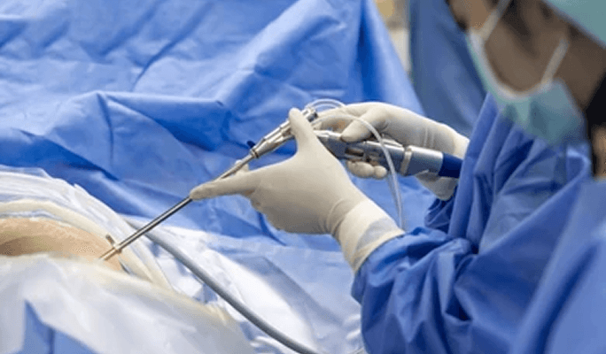 Discectomy