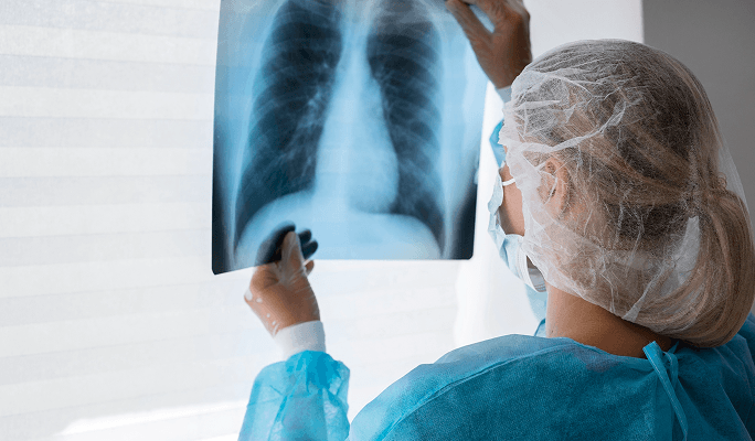 Lung Cancer