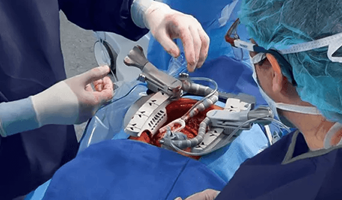 Open Heart Surgery