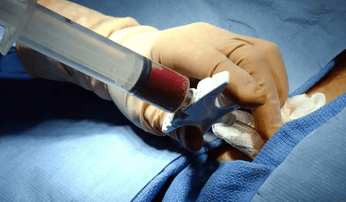 Hematopoietic Stem Cell Transplantation