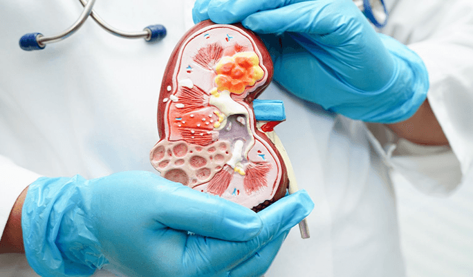 Nephrectomy