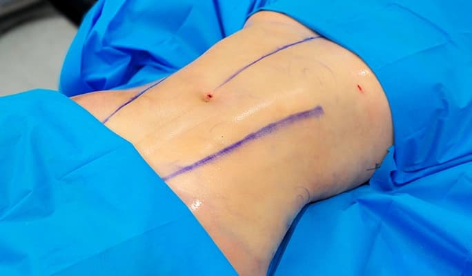 Abdominal Etching